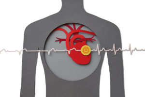 心脏节律图显示心房纤颤
