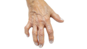 患有关节炎的手代表残疾人